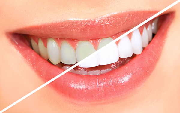 Các phương pháp tẩy trắng răng 3