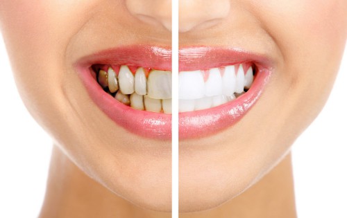 Những cách làm trắng răng tự nhiên nhanh nhất 3