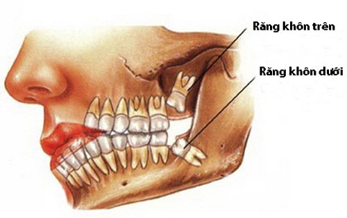 Một số thông tin về răng khôn 2