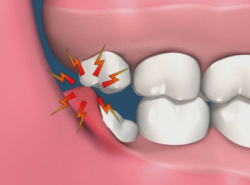 Nguyên nhân dẫn đến nhổ răng khôn 2