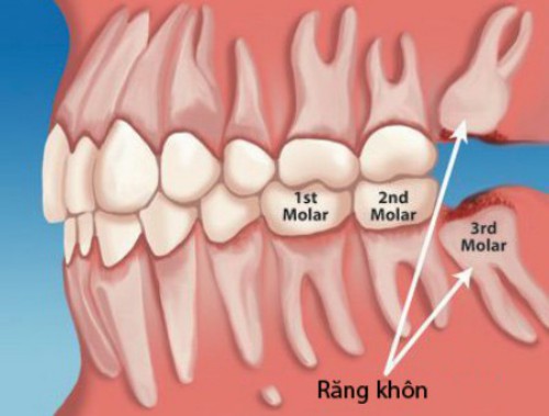 Nguyên nhân dẫn đến nhổ răng khôn 3