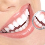 Mặt dán Veneer sứ thẩm mỹ bảo tồn răng thật