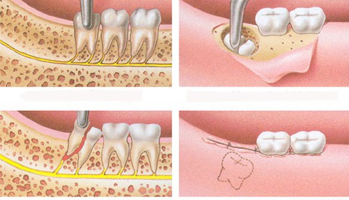 Cách nhổ răng khôn hiệu quả không gây viêm nhiễm