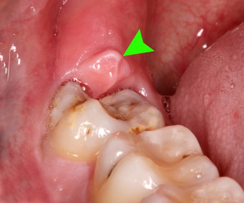 Cách nhổ răng khôn hiệu quả không gây viêm nhiễm