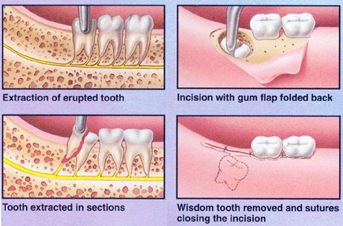 Nhổ răng khôn có ảnh hưởng đến sức khỏe thần kinh 4