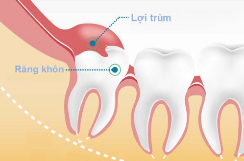 Nhổ răng khôn có ảnh hưởng đến sức khỏe thần kinh 5
