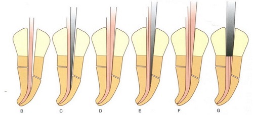 Những điều cần biết về bệnh lý tủy răng 2