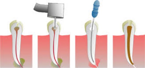 Diễn biến của bệnh viêm tủy răng 1