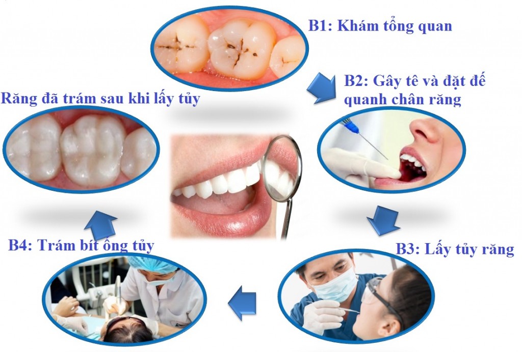 Các bước điều trị lấy tủy răng viêm Các bước điều trị lấy tủy răng viêm