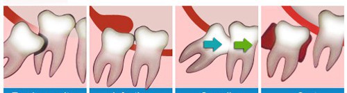 Răng khôn và bệnh lý từ răng khôn