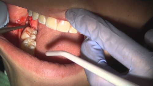 Răng khôn khi nào nên nhổ? 4