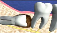 Cách nhổ răng khôn hiệu quả không gây viêm nhiễm
