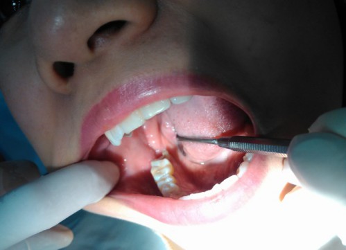 Qúa trình phục hồi sau khi nhổ răng khôn 3