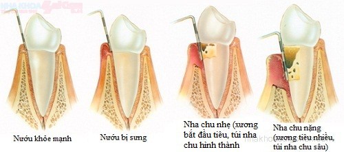 Tác dụng của cạo vôi răng định kỳ 5