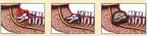 Cách nhổ răng khôn hiệu quả không gây viêm nhiễm 5