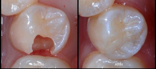 Trám răng lấy tủy 2