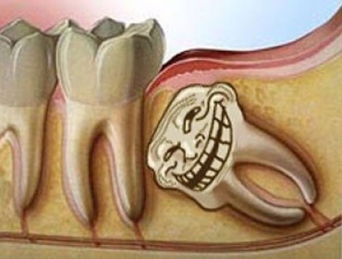 Răng khôn và bệnh lý từ răng khôn