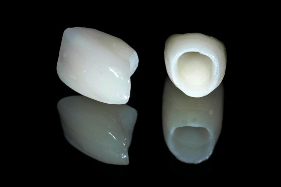 Hướng dẫn cách phân biệt các loại răng sứ 1