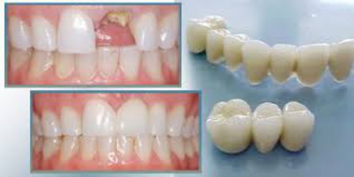 Cách phục hồi răng bị mẻ vỡ 1
