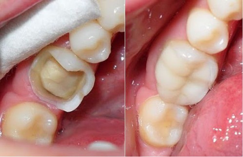 Cách phòng ngừa và khắc phục các nguyên nhân bị mẻ răng