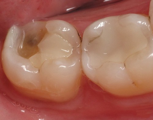 Cách phục hồi răng bị mẻ, vỡ