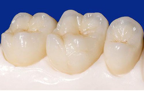 Kỹ thuật làm răng sứ CT 5 chiều 3