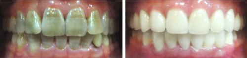 Có nên bọc răng sứ cho răng bị nhiễm Tetracycline