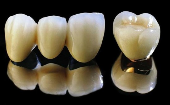 So sánh răng sứ titan với sứ Emax 1