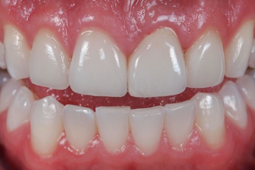 Một số nguyên nhân bị mẻ răng phổ biến nhất
