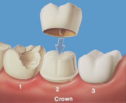 Cách khắc phục các nguyên nhân răng bị mẻ