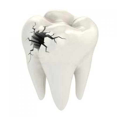 Một số nguyên nhân bị mẻ răng phổ biến nhất 1