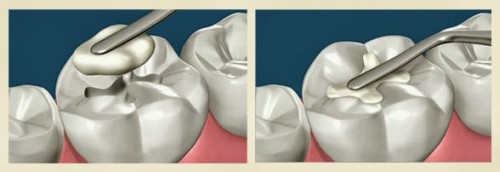 Cách phòng ngừa và khắc phục các nguyên nhân bị mẻ răng 2