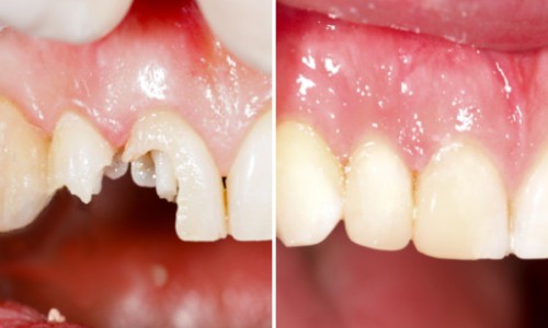 Cách phòng ngừa và khắc phục các nguyên nhân bị mẻ răng