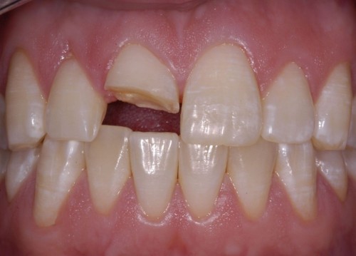 Cách khắc phục răng bị mẻ đơn giản và tiết 