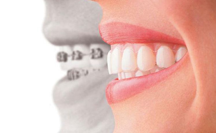 Cách chỉnh răng vẩu bằng niềng răng mắc cài 3
