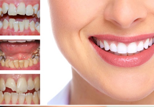 Răng sứ có ưu và nhược điểm gì? 1