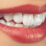 Trồng implant giá bao nhiêu ?