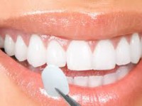 Mặt dán Veneer sứ thẩm mỹ