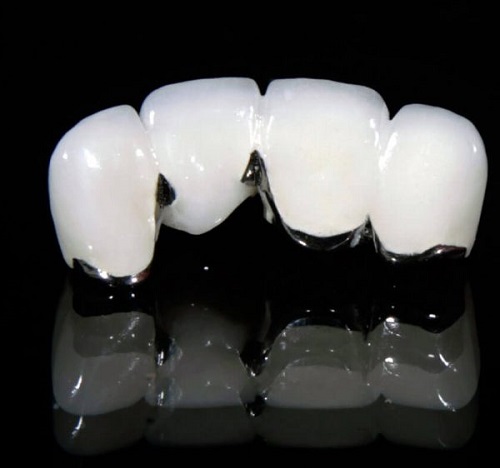 Hướng dẫn cách phân biệt các loại răng sứ 3