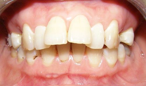 Niềng răng chỉnh hô có đau không? 1
