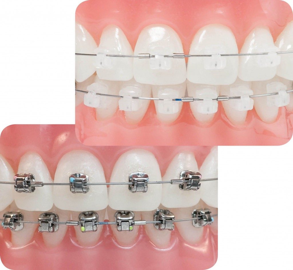 Niềng răng hô hàm trên và những điều bạn cần biết 2