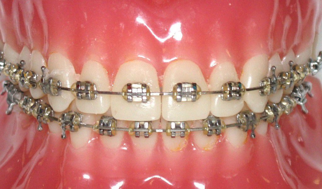 Quy trình niềng răng mắc cài kim loại 1