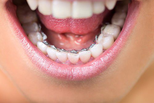 Phương pháp niềng răng mặt trong 2