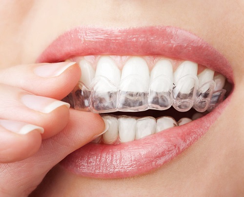 Niềng răng bằng nhựa 1