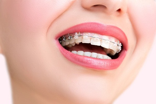 Những lý do sau chứng minh niềng răng có làm răng yếu đi không 1