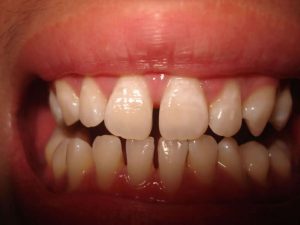 Chi phí cho quá trình niềng răng giá bao nhiêu tiền là hợp lý? 1