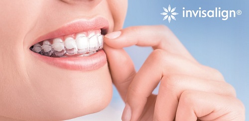 Niềng răng invisalign có đau không? 1