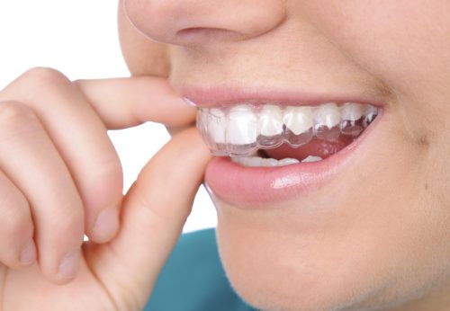 Những thông tin mới để biết niềng răng invisalign có tốt không 2