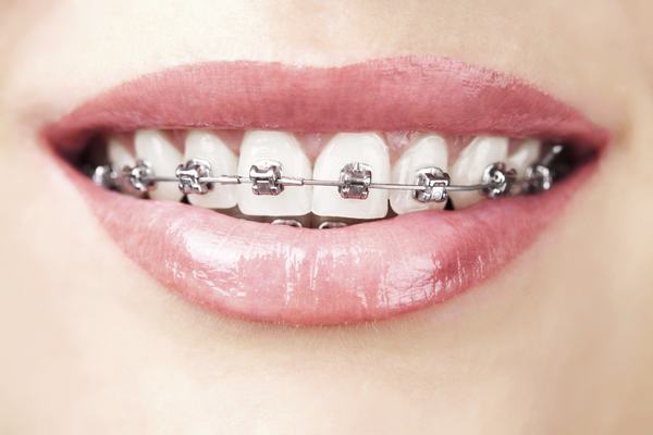Tìm hiểu ngay dịch vụ niềng răng một hàm có được không 2