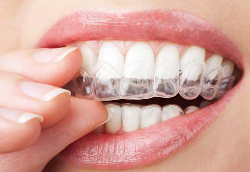 Tìm hiểu ngay dịch vụ niềng răng một hàm có được không 3